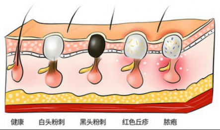 黑頭儀有用嗎？這么多款去黑頭的方法就屬它最有效