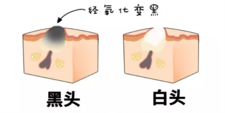 黑頭儀有用嗎？實(shí)力派去黑頭就選它！