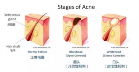 黑頭儀有用嗎？用了它終于擺脫了頑固黑頭！