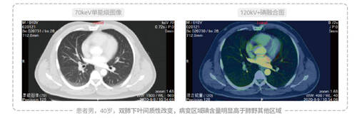 開影Precision 128精密斷層能譜CT獲得NMPA注冊證