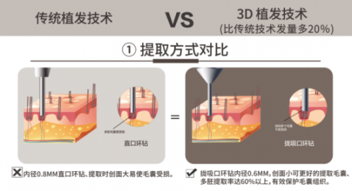 脫發(fā)呈現(xiàn)低齡化趨勢(shì)，常州新生植發(fā)：3D植發(fā)成為治脫有力手段