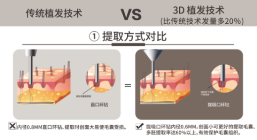 溫州新生植發(fā)：3D植發(fā)技術(shù)享譽國際，受毛發(fā)領(lǐng)域?qū)＜屹澷p